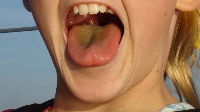 Why is my tongue greenish yellow?
