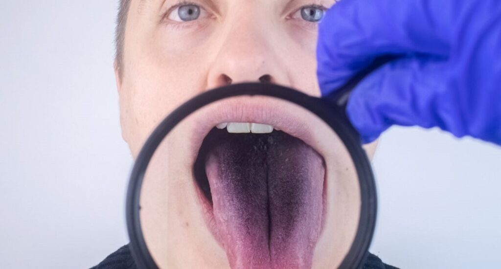What is Purple Tongue a Symptom Of?