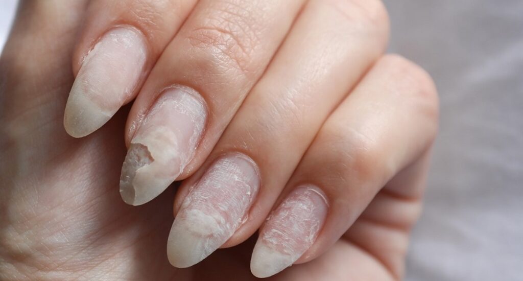 Why Do Nails Get Damaged?